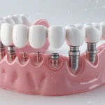 Full arch dental implants