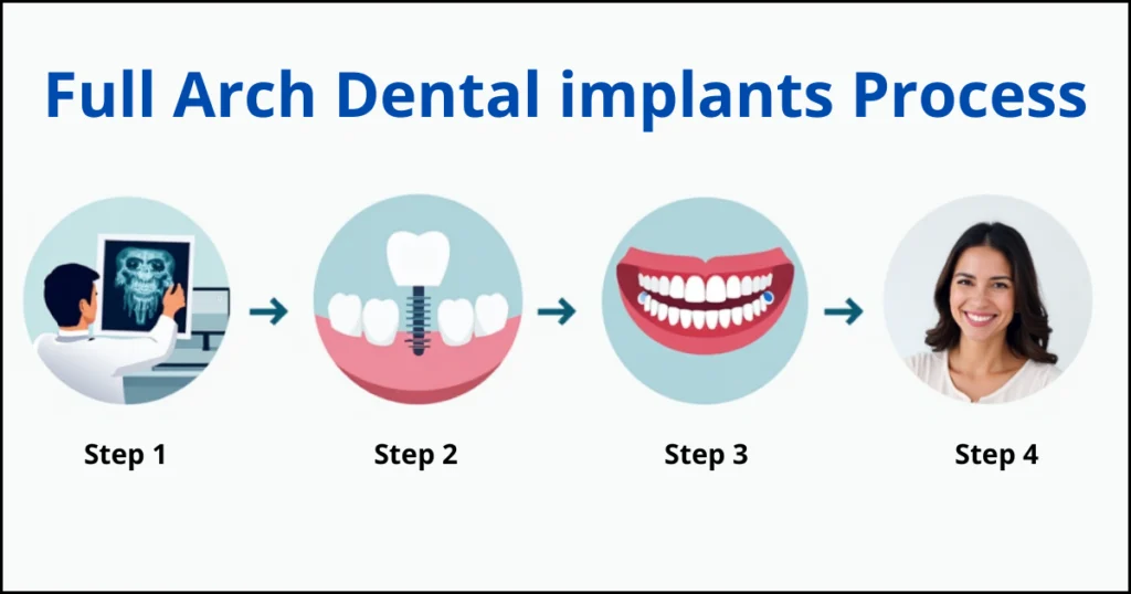 Full Arch Dental implants